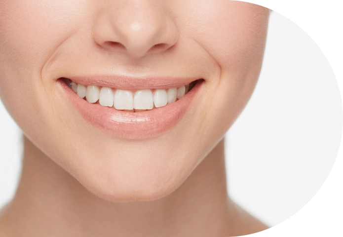 Carillas dentales para mejorar la forma y estética de la sonrisa