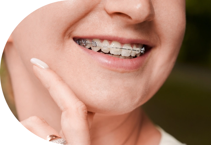 Tratamiento de ortodoncia con brackets